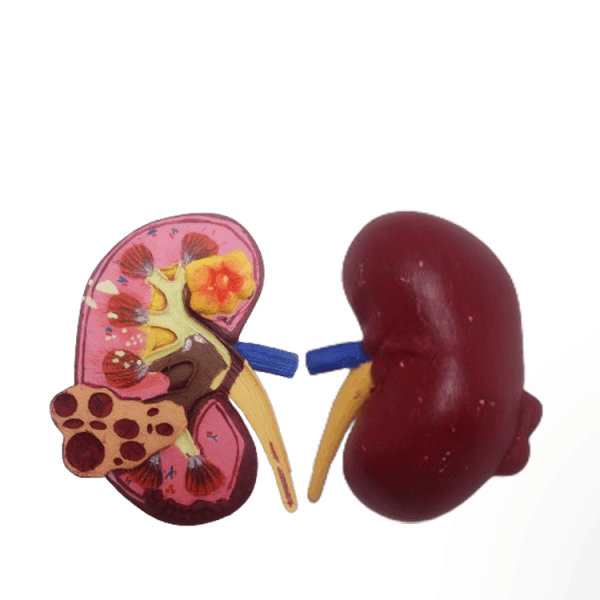 Kidney Renal Failure